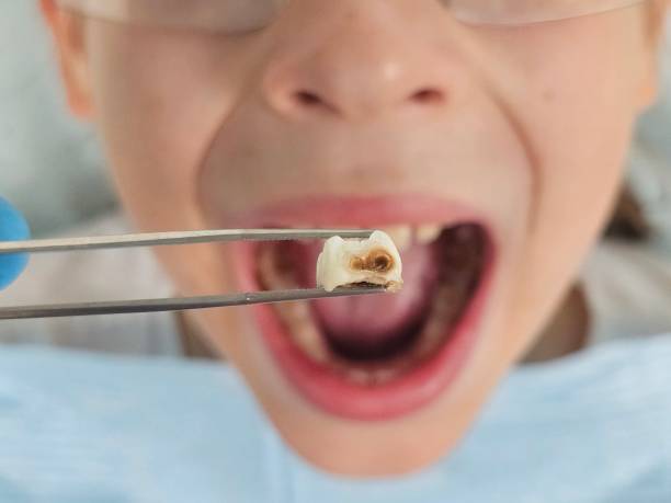 Best Same-Day Emergency Dental Services in Grottoes, VA